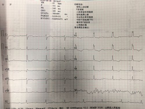 朔州市首例临时起搏器保护下植入式心律转复