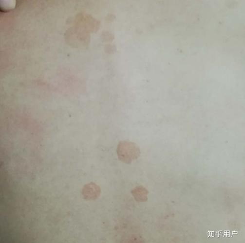 汗斑有什么好的药物可以有效快速的治疗吗?