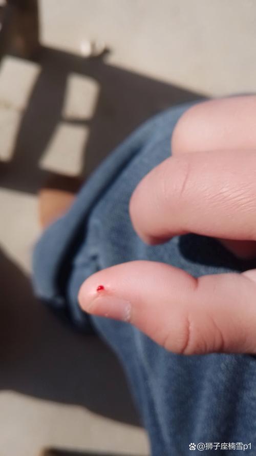 被仓鼠咬成这样,有救吗