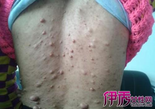 皮下脂肪瘤怎么治疗 盘点几大其饮食注意事项