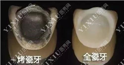 烤瓷牙和全瓷牙的不同之处