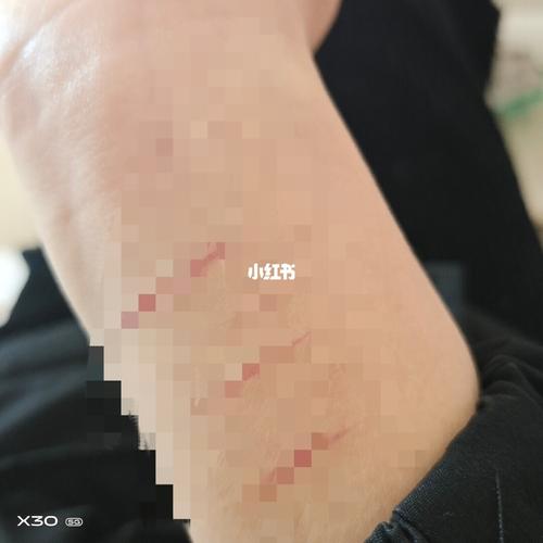 手腕上伤口挺多的 结痂了 但那块划开的地方始终愈合不了 怕被别人
