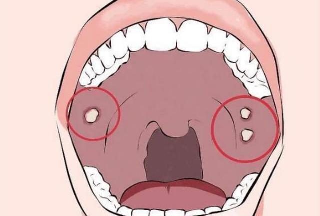 口腔有癌始于溃疡,长期口腔溃疡,再加以下任一症状