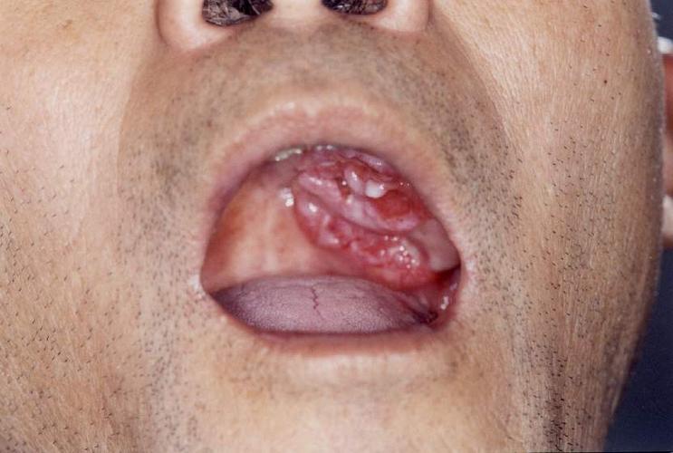 扁桃体恶性肿瘤的症状有哪些