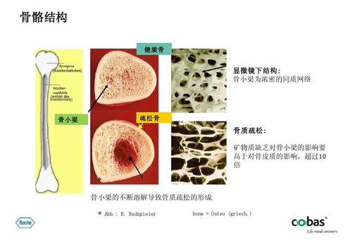 骨骼结构 健康骨 显微镜下结构: 骨小梁为浓密的同质网络 骨小梁 疏松