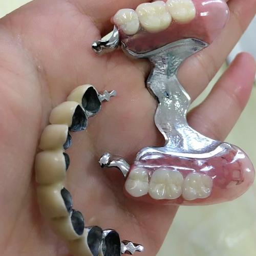 后牙缺失太多,不用再镶每顿饭都得摘下来刷的传统活动