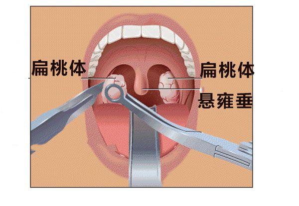 扁桃体腺样体切除手术需要全部切除吗