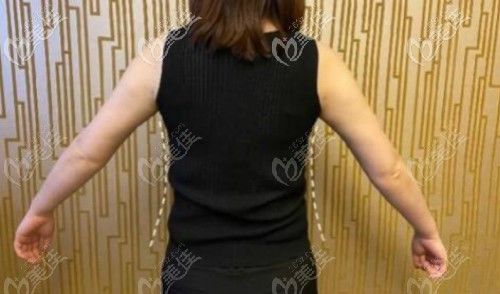 在福州美贝尔做过背部快乐吸脂的人来说说效果怎么样