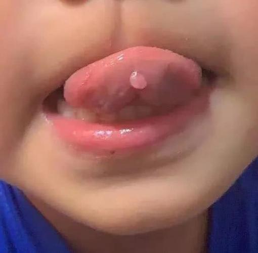 粘液腺囊肿是咋回事?