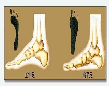医院医生对此指出:扁平足主要是由于某些原因使足骨形态异常,肌肉萎缩