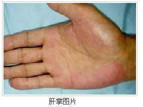 肝掌及蜘蛛痣图片
