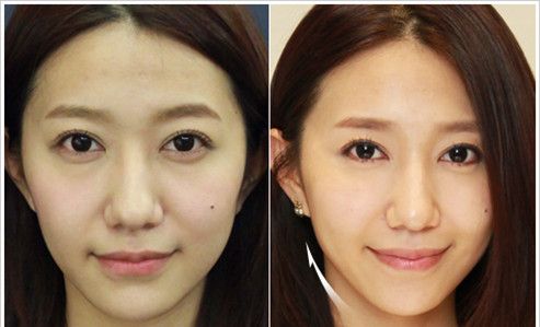 洛阳华美玻尿酸丰面颊