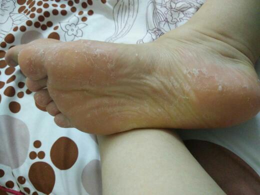 我容易手心和脚心出汗,之前穿了小平底皮鞋,就出现脚上长泡泡,在指甲