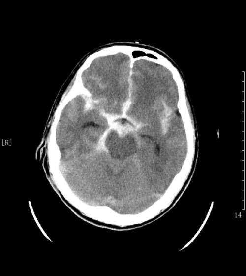 ct检查(蛛网膜下腔出血)