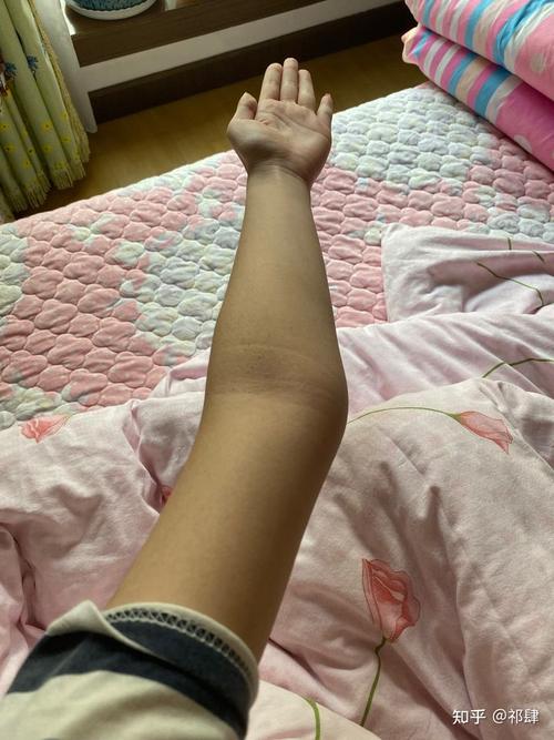 肘外翻是一种怎样的体验 如图?