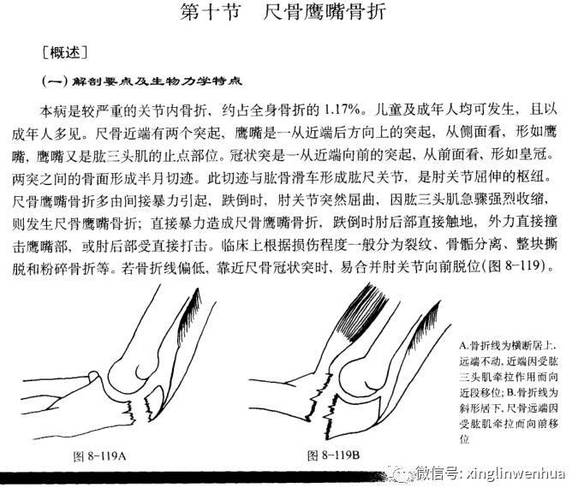 肘部尺骨鹰嘴骨折