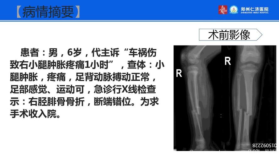小儿骨折病例分享