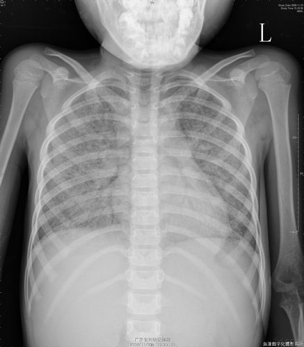 典型胸片(请看片)