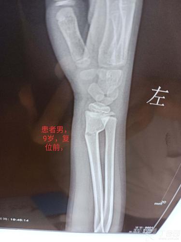 儿童桡骨远端骨折,欢迎大家交流经验.