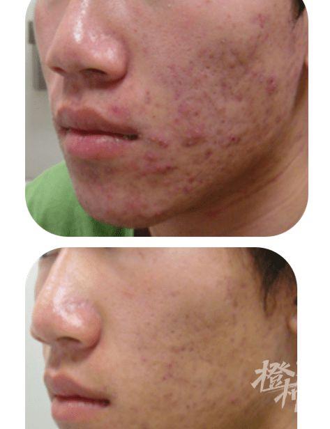 反复爆痘满脸痘坑,20岁男生"果酸换肤"后找回自信