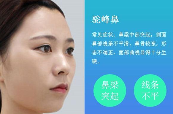 鼻   中度型驼峰的鼻根端超过两内眦连线,重度型驼峰的鼻根端至额鼻缝