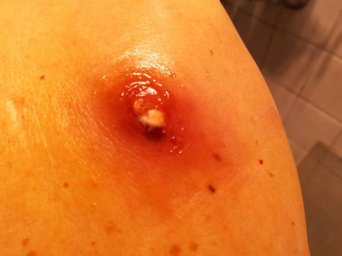 时拍的,红肿范围大概5厘米,疮口大约在1厘米深细二厘米,敢取出脓栓1,5