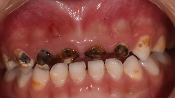 孩子牙龈上有"鼓包"怎么办?