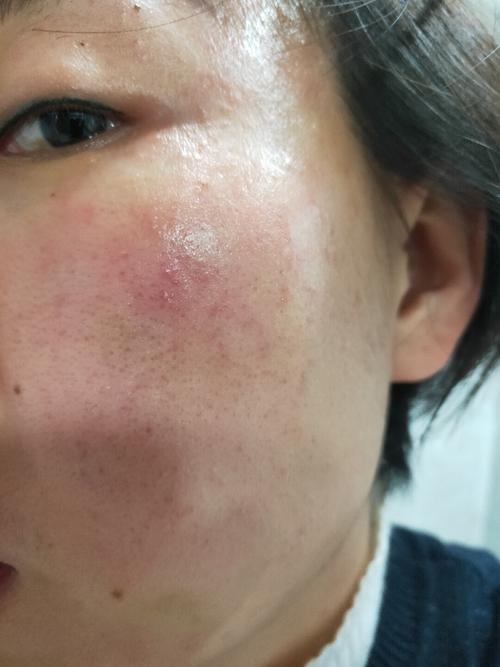 过敏终于好了_玻尿酸_皮肤过敏_补水保湿_护肤品_美妆