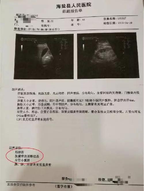 洪某某,身高170cm,体重88kg,体检发现高血脂,重度脂肪肝,左肾小囊肿