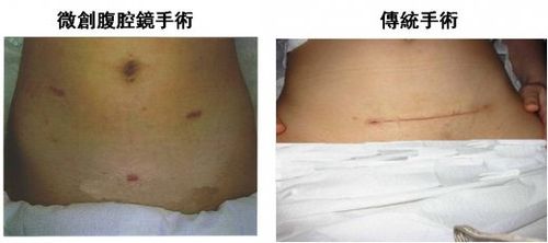 肌瘤手术,进展成「腹腔镜子宫肌瘤原位切除术」与「两侧子宫动脉阻断