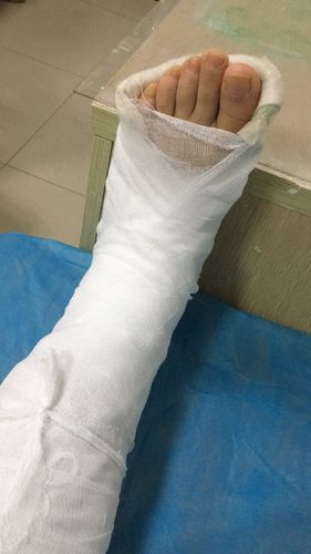 某一天下班,一不小心,将自己的脚绑上了石膏