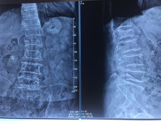 锥体成型术—微创治疗腰椎压缩性骨折