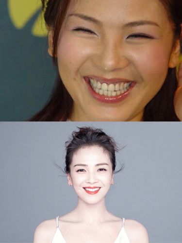 牙齿贴片——帮你c位出道·95女明星笑起来好看的