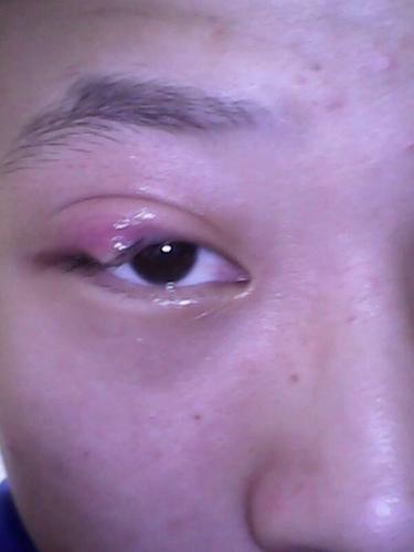 去医院把 评论| 2013-11-17 20:42热心网友 去医院看看,看着挺严重的