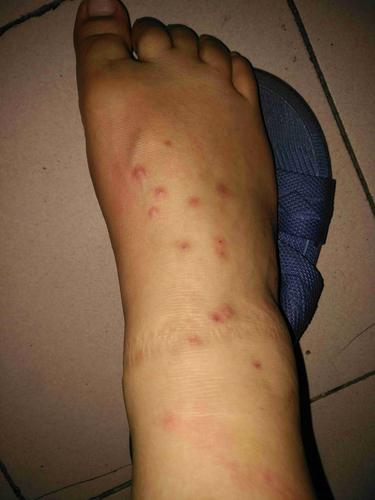 这是什么皮肤病