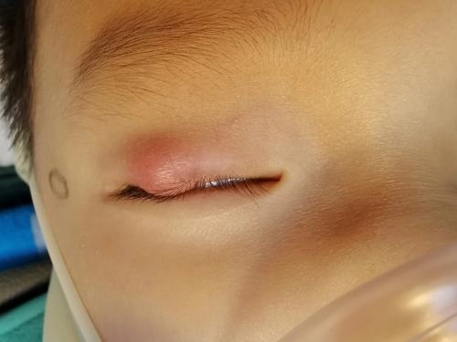 如何辨别幼儿麦粒肿与霰粒肿?