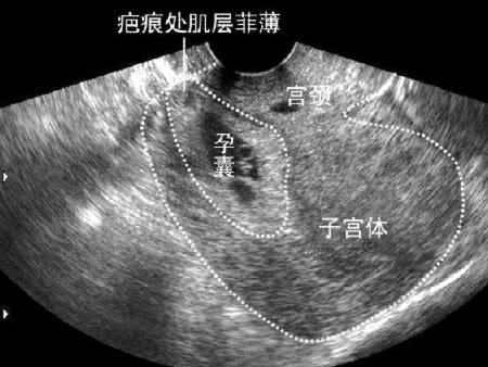 子宫疤痕处妊娠