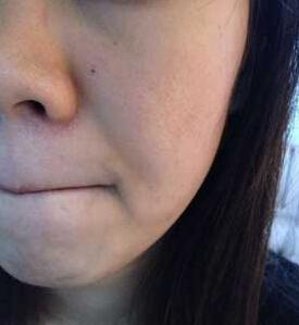 激光去痘坑痘印七天恢复过程,有图!