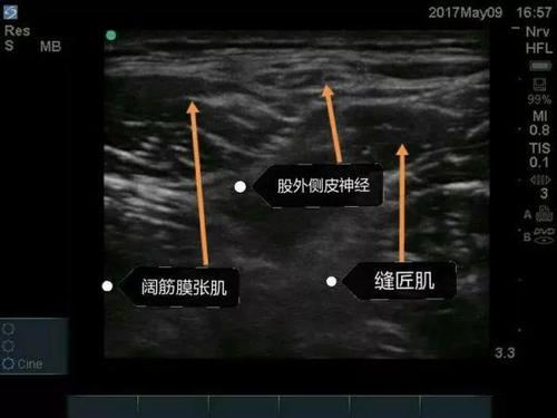 如何从零开始学习超声引导下神经阻滞?这篇文章你不可