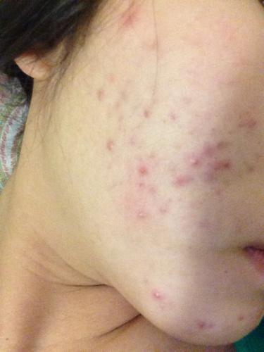 不知道为什么脸最近会成片成片的起痘,以前从来没有过,就是红肿一直都