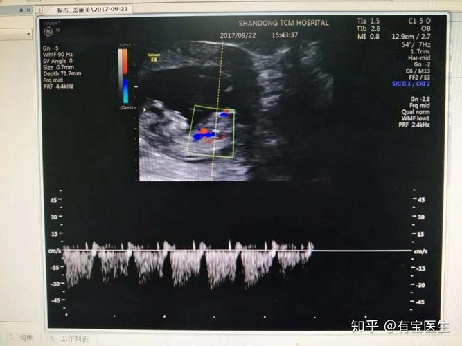 三尖瓣反流,完全性心内膜垫缺损,鼻骨显示不清,静脉导管a波反向等都是