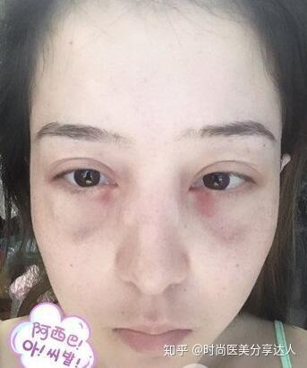 内切去眼袋术后恢复过程案例对比分享