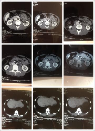 请医生帮我看看片,是肝血管瘤肝囊肿还