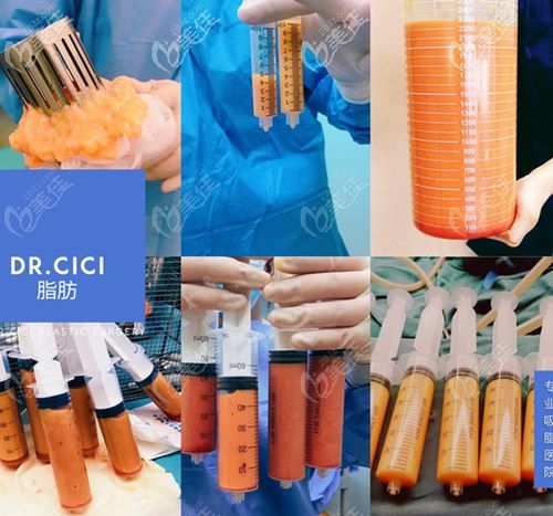 南京米嘉drcici医院抽出来的脂肪