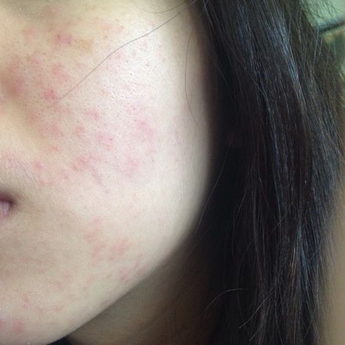 脸上长满了红点,是毛囊炎还是过敏性皮炎?毛孔里有白色东西,扣了很红.