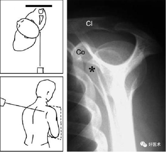 x线正切于"肩胛胸关节",并且可对肩峰下间隙进行较好的评估肩关节出口