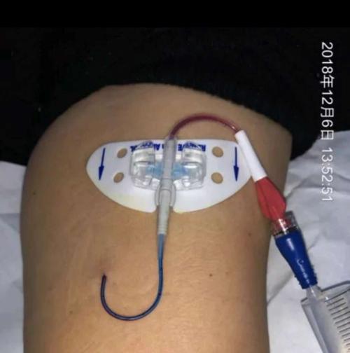 思乐扣固定效果