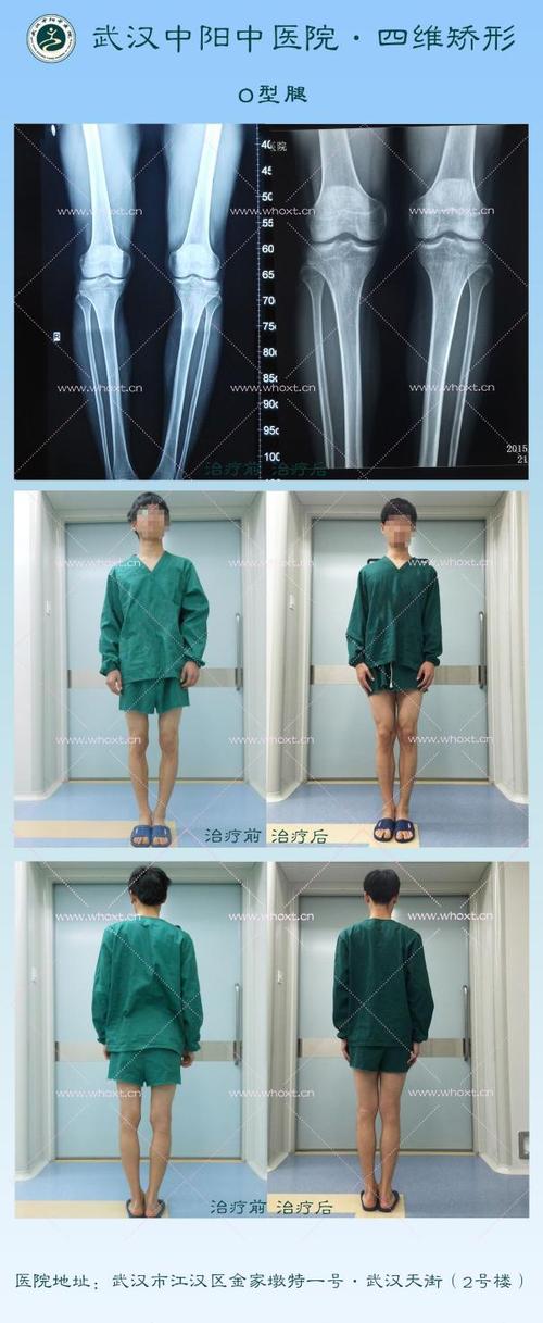 正常人小腿骨头是弯的吗?o型腿是骨头弯了?武汉中阳四维矫形矫正