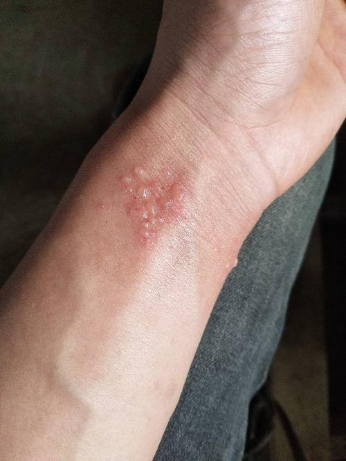 一觉醒来手腕上就这样了.好多水泡.是怎么了?
