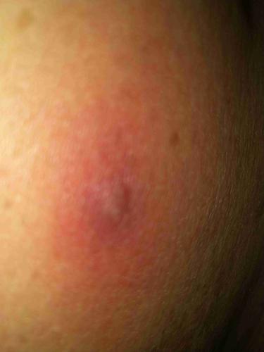 肚子上不知道怎么起的疙瘩,很疼,不痒,略硬,红肿约1cm